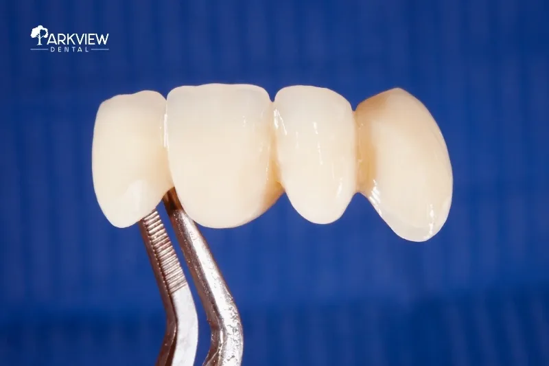 Ảnh chụp răng sứ Cercon