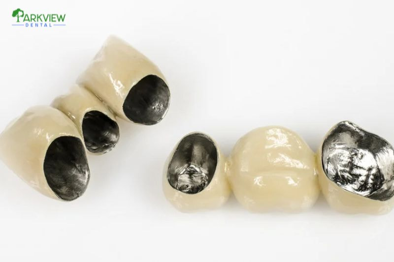 Bọc răng sứ kim loại giá dao động từ 5.000.000 - 10.000.000 VND/răng