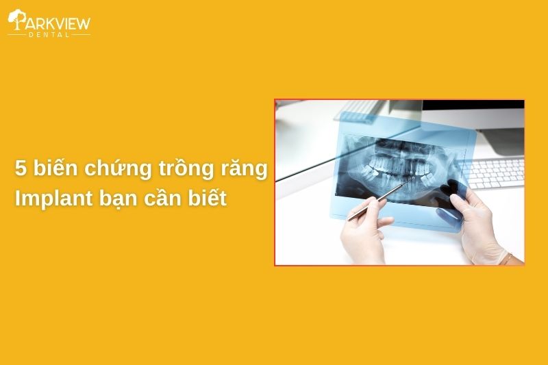 5 biến chứng trồng răng Implant nguy hiểm bạn cần biết