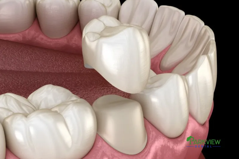 Bọc răng sứ là phương pháp tuyệt vời giúp khắc phục các khuyết điểm như răng xỉn màu, sứt mẻ