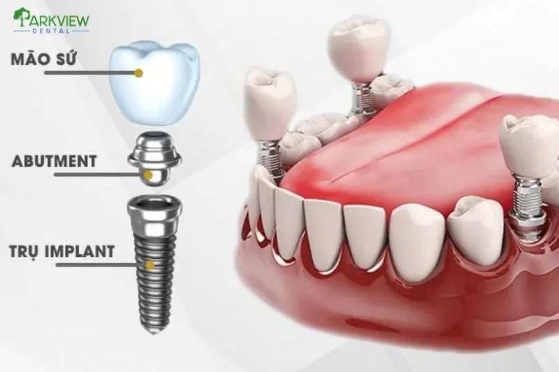 Các yếu tố ảnh hưởng đến chi phí trồng răng Implant All On 4
