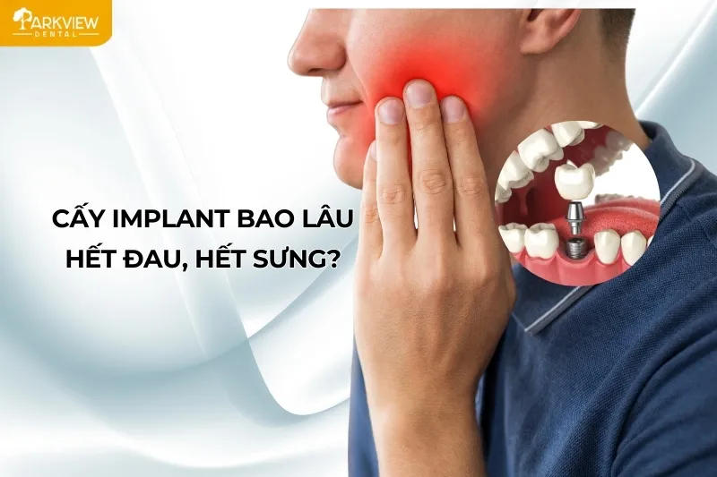 Cấy Implant bao lâu hết đau, hết sưng?