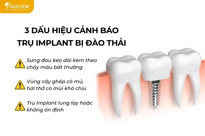 Dấu hiệu cảnh báo trụ Implant bị đào thải