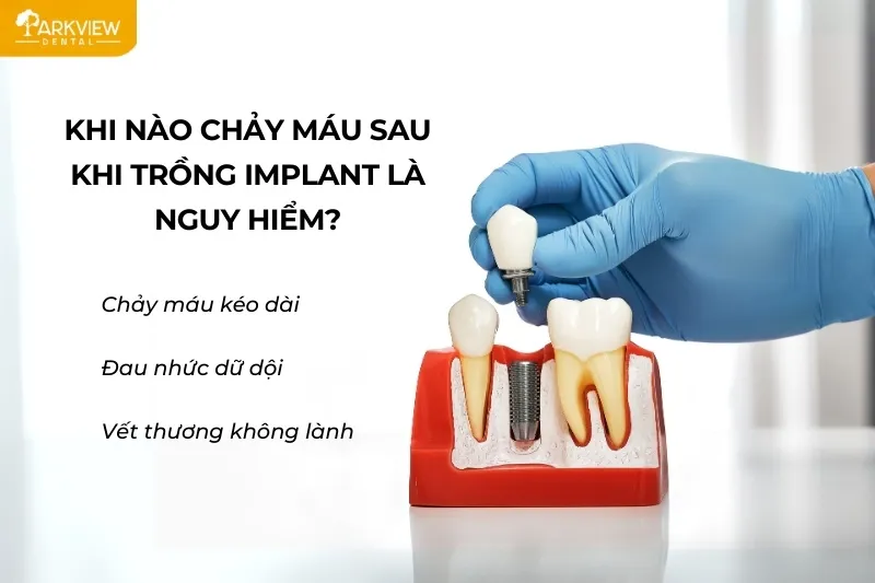 Dấu hiệu chảy máu bất thường sau khi trồng răng Implant
