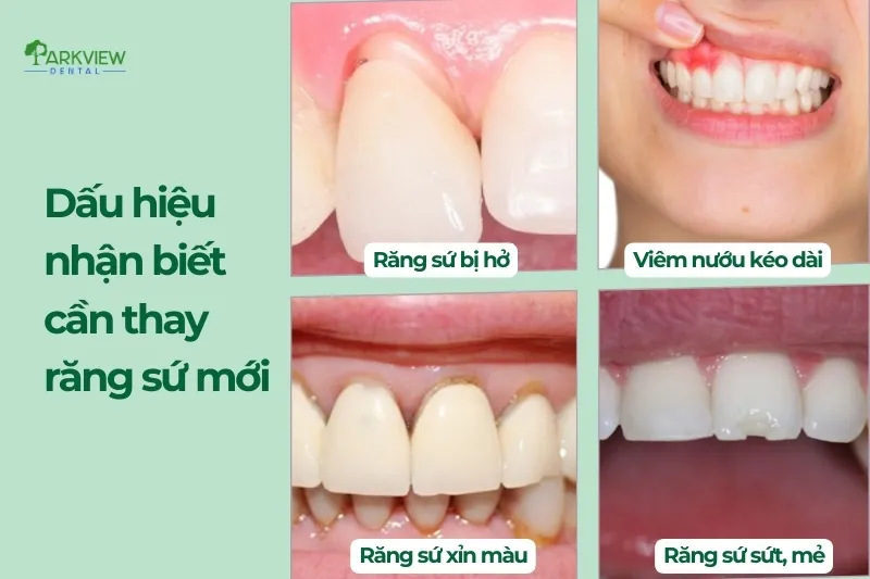 Dấu hiệu nhận biết cần thay răng sứ mới