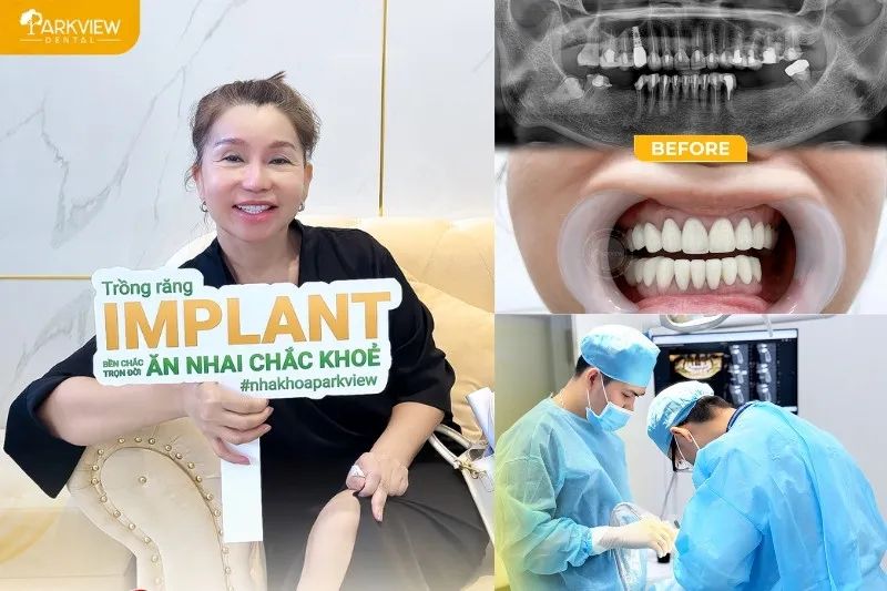 Feedback của khách hàng sau khi trồng răng Implant tại Nha khoa Parkview 