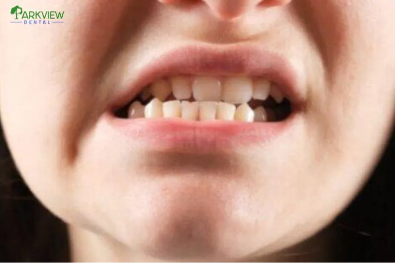 Hậu quả của việc bọc răng sứ bị lệch khớp cắn