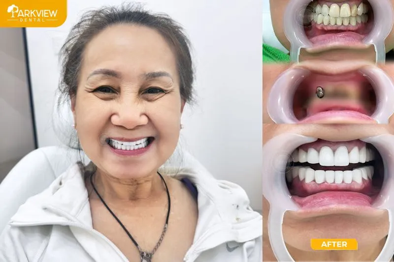 Hình ảnh khách hàng bọc lại răng sứ khi răng sứ đã bị viêm nhiễm