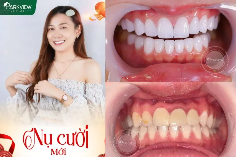 Hình ảnh khách hàng bọc răng sứ tại Nha khoa Parkview
