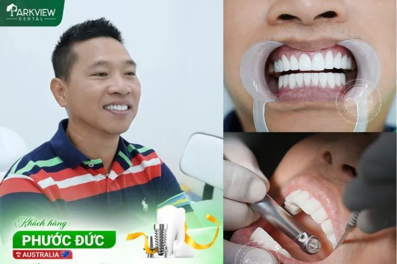 Hình ảnh khách hàng trồng răng Implant tại Nha khoa Parkview