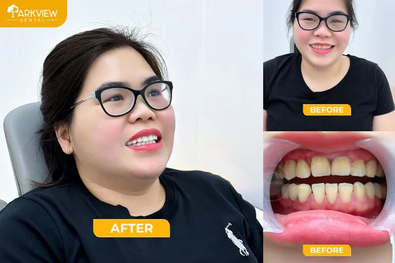 Khách hàng bọc răng sứ tại Nha khoa Parkview