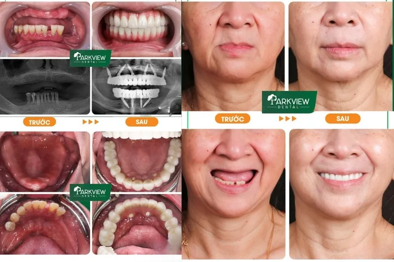 Hình ảnh khách hàng trước và sau khi trồng răng tại nha khoa Parkview