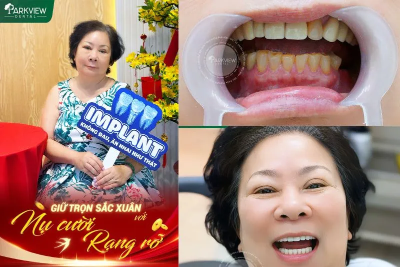 Hình ảnh thực tế khách hàng trồng răng Implant tại Nha khoa Parkview