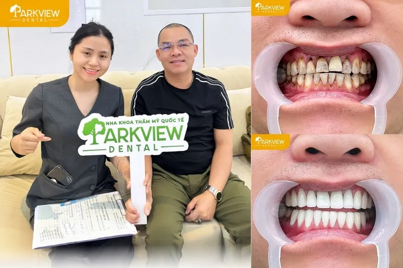 Khách hàng bọc răng sứ Cercon HT tại nha khoa Parkview