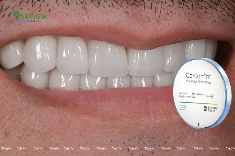 Khách hàng thực tế là răng sứ Cercon HT tại Nha khoa Parkview