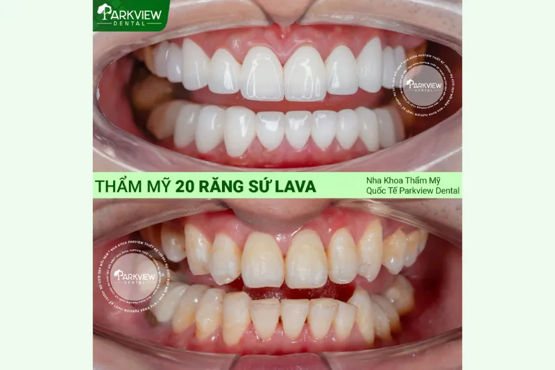 Khách hàng thực tế sau khi bọc sứ Lava tại Nha Khoa Thẩm Mỹ Quốc Tế Parkview Dental