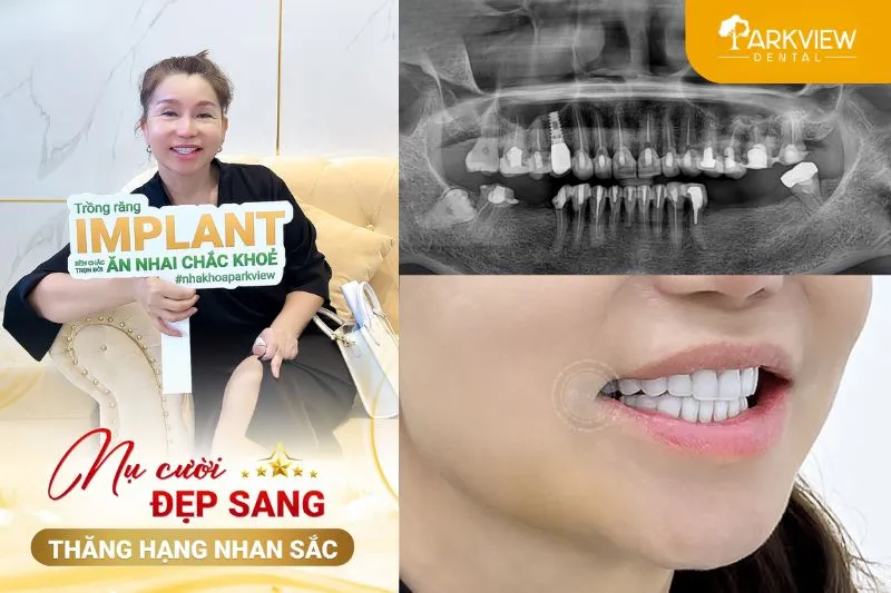 Khách hàng thực tế trồng răng Implant tại nha khoa Parkview
