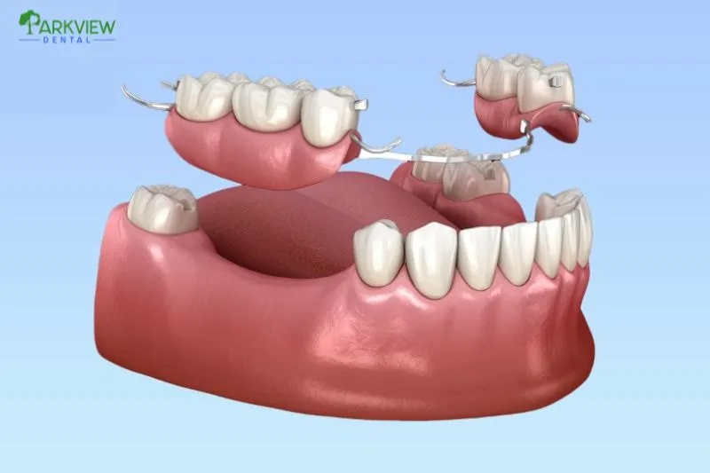 Khi nào cần thay mới răng sứ