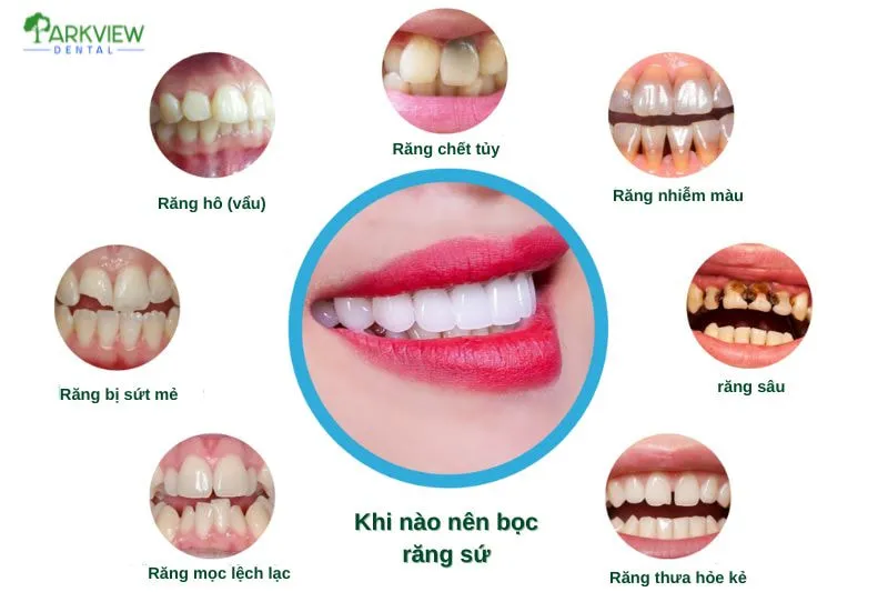 Khi nào nên bọc răng sứ