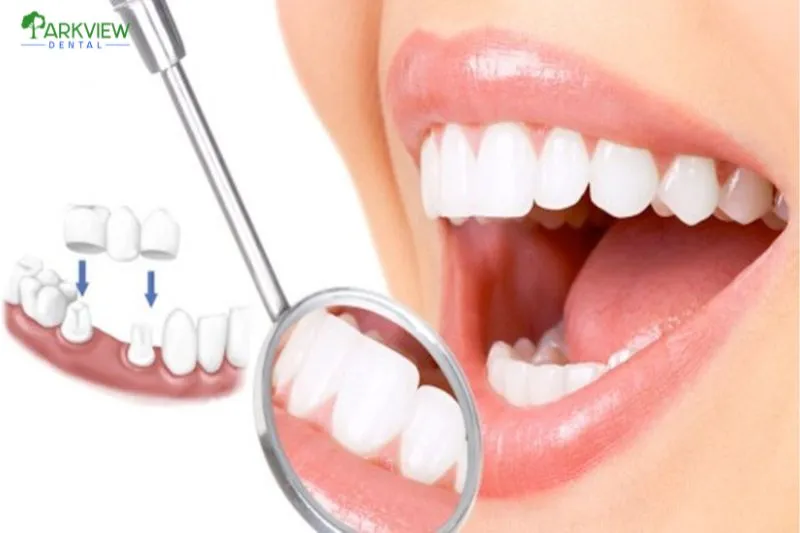 Thay mới răng sứ tại nha khoa Parkview uy tín, chất lượng