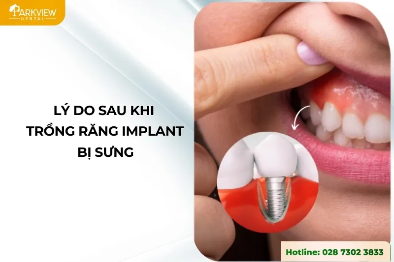 Lý do sau khi trồng răng Implant bị sưng