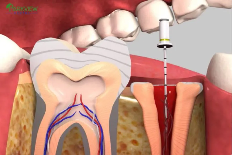 Nguyên nhân răng bọc sứ bị viêm tủy