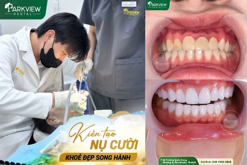 Nha khoa Parkview- Địa chỉ bọc răng sứ Mỹ uy tín