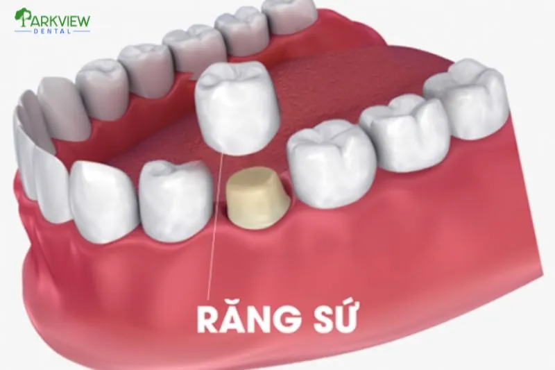 Những lưu ý quan trọng khi bọc răng sứ