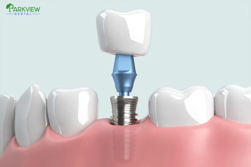 Những trường hợp cần tháo trụ Implant