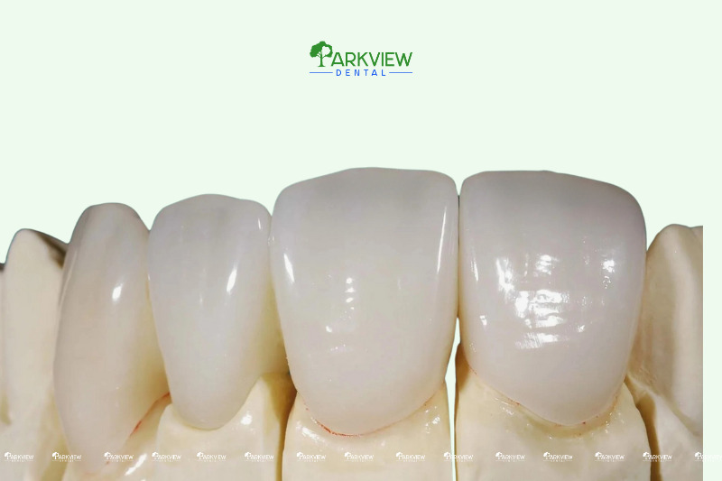 Những ưu điểm nổi bật của răng Ceramill