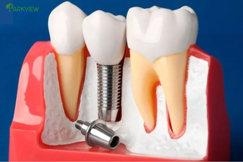Quá trình tháo trụ Implant diễn ra như thế nào?