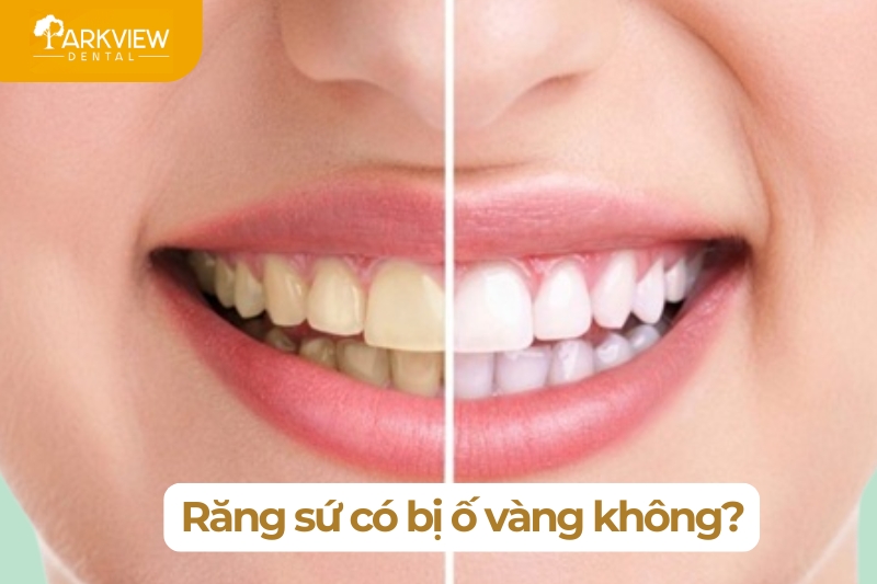 Răng Sứ Có Bị Ố Vàng Không? Nguyên Nhân Và Cách Khắc Phục