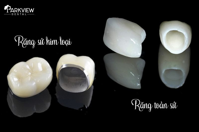 Răng sứ kim loại và răng sứ toàn sứ
