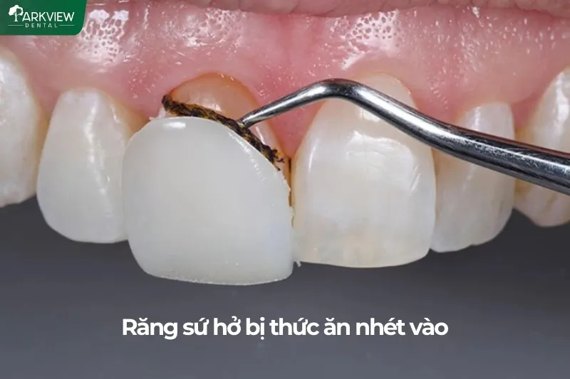 Răng sứ hở bị thức ăn nhét vào