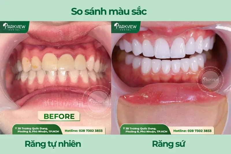 So sánh màu sắc răng tự nhiên và răng sứ