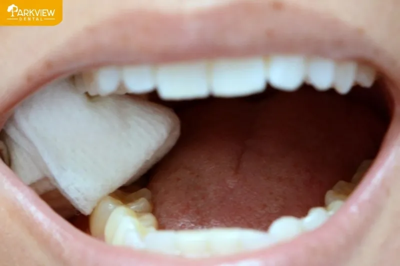 Sử dụng bông gạc cầm máu sau khi trồng răng Implant
