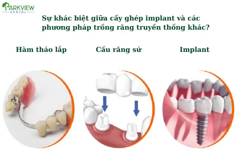 Sự khác biệt giữa cấy ghép Implant và các phương pháp trồng răng truyền thống khác