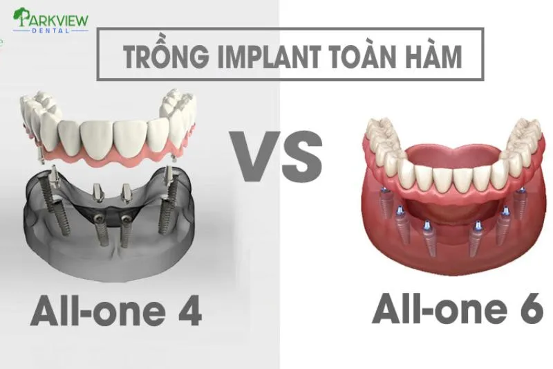 Sự khác nhau giữa All On 4 và All On 6