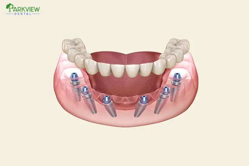 Trồng răng Implant All On 6 giá rẻ có tốt không?
