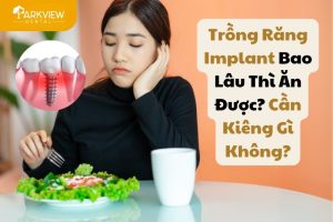 Trồng Răng Implant Bao Lâu Thì Ăn Được? Cần Kiêng Gì Không?
