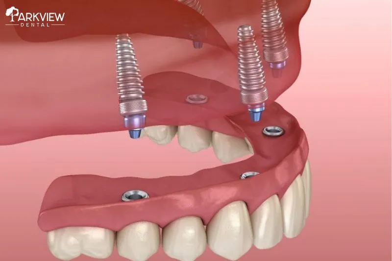 Trồng răng Implant có tháo ra được không?