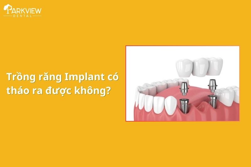 Trồng răng Implant có tháo ra được không? [Giải đáp]