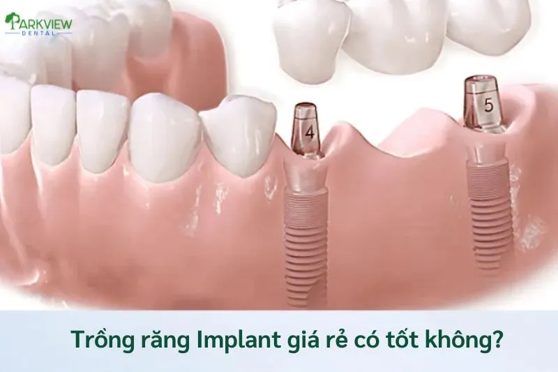 Trồng răng implant giá rẻ có tốt không?
