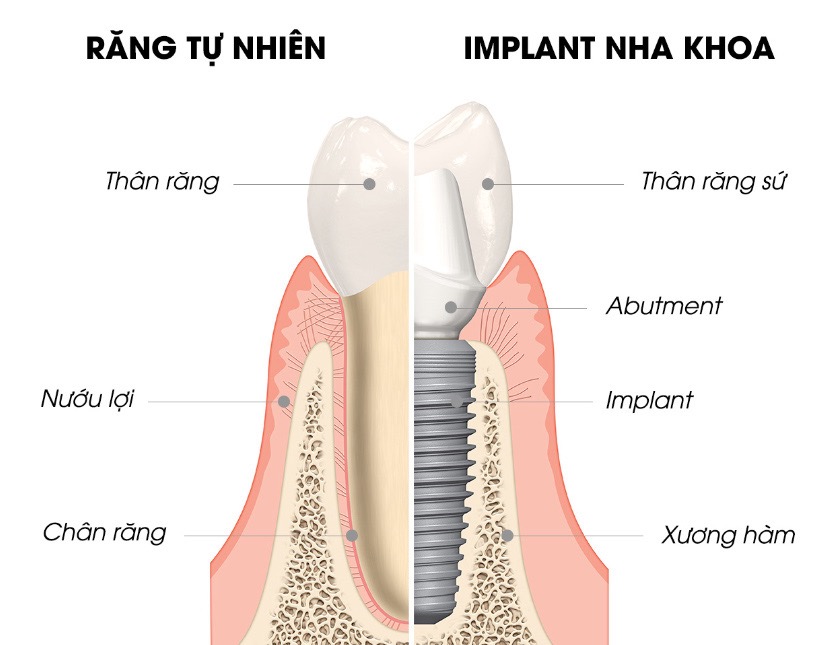 So sánh cấu tạo của Implant và Răng tự nhiên